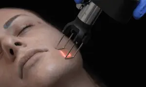 Trattamento viso con laser per ridurre le rughe. Un manipolo emette un fascio luminoso sulla pelle.