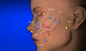 Punti riassorbibili colorati indicano aree di trattamento sul viso, con distanze misurate.
