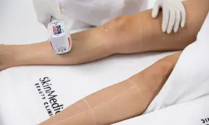 Trattamento laser per la rimozione dei peli, con attenzione alle possibili controindicazioni. Mani guantate guidano l'apparecchio sulla gamba.
