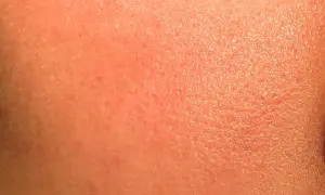 Pelle arrossata e secca, con piccole scaglie visibili, possibili effetti collaterali del retinolo.