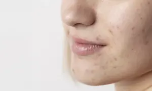 Primo piano del viso di una giovane donna con segni di acne. La pelle mostra imperfezioni, rossori e brufoli, evidenziando la necessità di una **pulizia viso acne**.