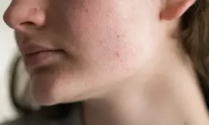 Primo piano del viso di una persona con rossori e imperfezioni, indicativi di una barriera cutanea danneggiata.