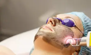 Donna con maschera al carbone per un trattamento laser. Il carbon peel prima e dopo trasforma la pelle.