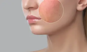 Primo piano del viso di una donna con un cerchio che evidenzia un'area arrossata e porosa, indicativa di eritema da calore.