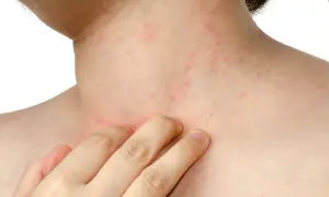 Pelle arrossata e irritata sul collo e sul petto, con piccole macchie rosse, indicative di dermatite da stress.