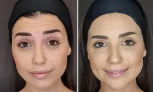 Confronto tra fronte con rughe e fronte levigata, mostrando la differenza tra botox e filler.