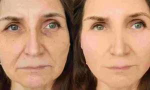 Prima e dopo: un lifting occhi che trasforma rughe profonde in pelle liscia e luminosa.