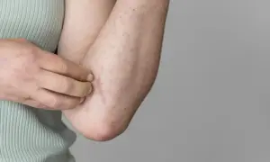 Braccio con eritema e puntini rossi, segno di possibile allergia al sudore.