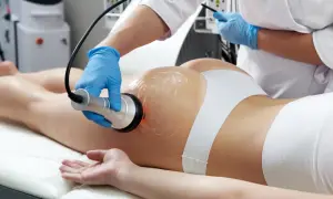 Trattamento estetico con manipolo per sciogliere grasso localizzato su glutei e gambe.