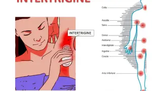 Intertrigine: rossore e puzza sotto il seno e in altre zone del corpo.