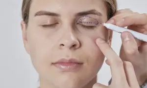 Medico disegna contorno per filler palpebre cadenti.