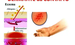 Illustrazione della dermatite da contatto: allergeni penetrano nella pelle causando infiammazione, con un ingrandimento di un'eruzione cutanea e un braccio affetto.