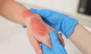 Mano con ustione rossa e infiammata, assistita da mani con guanti blu. Impara cosa fare in caso di ustione.