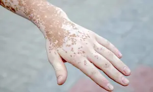 Mano con psoriasi macchie bianche e marroni, un dettaglio della pelle che mostra la vitiligine.