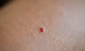 Primo piano della pelle con un piccolo punto rosso, simile a micro bollicine sulla pelle.