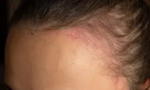 Fronte con arrossamento e squame, tipici della dermatite seborroica. La pelle appare irritata e leggermente desquamata vicino all'attaccatura dei capelli.