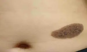 Macchia marrone sulla pelle tipo bruciatura, con una texture ruvida e irregolare, vicina all'ombelico.