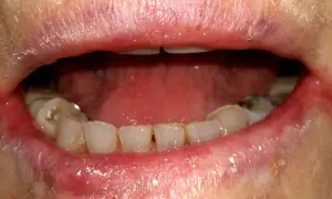 Labbra arrossate e screpolate, con segni di cheilite angolare agli angoli della bocca. Denti visibili, alcuni con macchie.