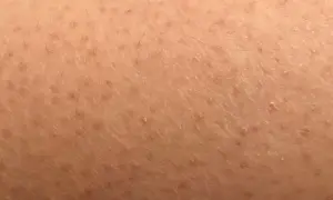 Pelle con cheratosi pilare, piccoli puntini rossi e peli incarniti. Scopri come curarla.