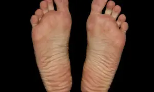 Piante dei piedi con dita separate e pelle rugosa, un segno di camminate lunghe, forse un occhio di pernice in formazione.