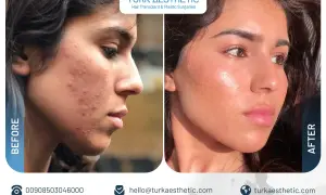 Prima e dopo laser CO2: pelle con acne trasformata in viso luminoso e senza imperfezioni.