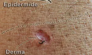 Ingrandimento della pelle che mostra l'epidermide superficiale e la derma sottostante, con una piccola lesione.