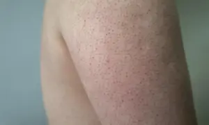 Pelle con follicolite alle gambe, piccoli puntini rossi e peli incarniti. Scopri come curarla per una pelle liscia e sana.