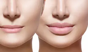 Prima e dopo: labbra più piene e definite, un esempio di come rimpolpare le labbra in modo naturale per un sorriso radioso.