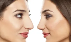 Profilo di due donne, una con naso più pronunciato, l'altra con naso modificato. Attenzione al rinofiller rischio cecità.