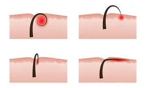 Illustrazione di peli incarniti e infezione cutanea. Diverse fasi di un pelo che cresce sotto la pelle, causando infiammazione e rossore.