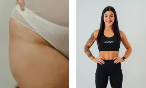 Dettaglio di culotte de cheval, causa di inestetismi della pelle, accanto a una donna sorridente in abbigliamento sportivo.