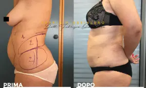 Carbossiterapia pancia prima e dopo: confronto visivo dei risultati. La foto mostra una trasformazione della silhouette.