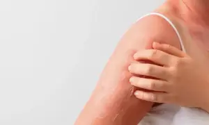 Spalla e collo arrossati con desquamazione, segno di cheratosi della pelle. La mano sfiora la zona irritata.