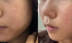 Confronto laser frazionato prima e dopo: pelle con pori dilatati e rossori prima, pelle più liscia e uniforme dopo il trattamento.