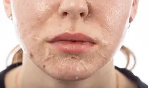 Pelle del viso che si sfalda dopo un trattamento. Il peeling viso cos'è? Un processo di rinnovamento cutaneo.