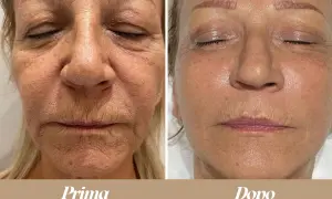Confronto prima/dopo: il terzo superiore del viso mostra una pelle più liscia e luminosa dopo il trattamento.