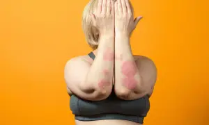 Donna con chiazze rosse sulle braccia, segno di psoriasi da stress. Copre il viso con le mani.