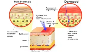 Confronto tra pelle normale e dermatite: la pelle sana ha cheratinociti fitti, mentre la dermatite mostra penetrazione di allergeni, infiammazione e perdita di acqua e grasso.