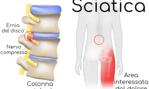 Ernia del disco comprime il nervo sciatico, causando dolore alla gamba. Illustrazione medica.