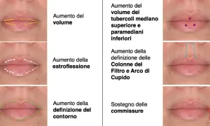 Esempi di filler labbra fatto male: labbra gonfie, asimmetriche o con contorni innaturali. Illustrazioni mostrano correzioni.
