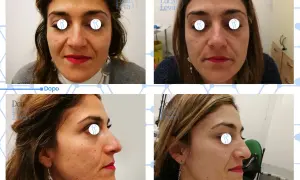 Prima e dopo un trattamento di laser ablativo viso per migliorare la texture della pelle e ridurre le imperfezioni.