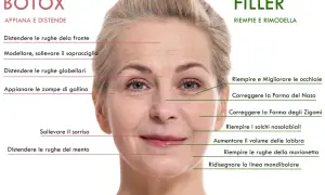 Volto di donna con indicazioni su dove fare botox per distendere rughe fronte, sopracciglia, zampe di gallina e mento.