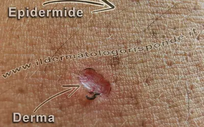Ingrandimento della pelle che mostra l'epidermide superficiale e la derma sottostante, con una piccola lesione.