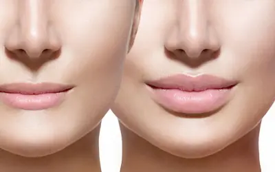 Prima e dopo: labbra più piene e definite, un esempio di come rimpolpare le labbra in modo naturale per un sorriso radioso.