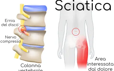 Ernia del disco comprime il nervo sciatico, causando dolore alla gamba. Illustrazione medica.
