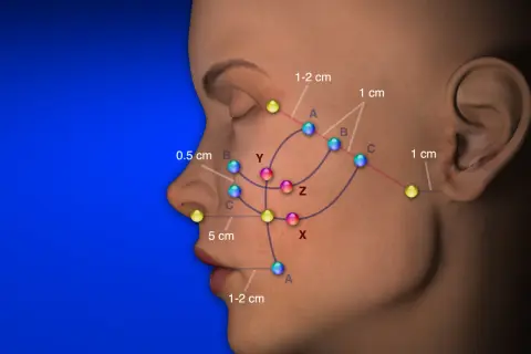 Punti riassorbibili colorati indicano aree di trattamento sul viso, con distanze misurate.