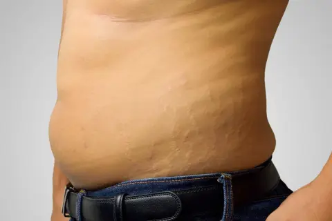 Addome con smagliature, un promemoria che la pelle è un organo che cambia.