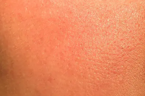 Pelle arrossata e secca, con piccole scaglie visibili, possibili effetti collaterali del retinolo.