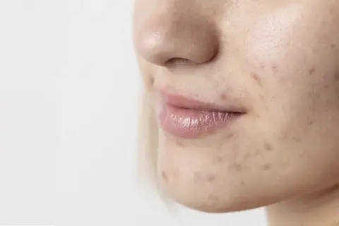 Primo piano del viso di una giovane donna con segni di acne. La pelle mostra imperfezioni, rossori e brufoli, evidenziando la necessità di una **pulizia viso acne**.