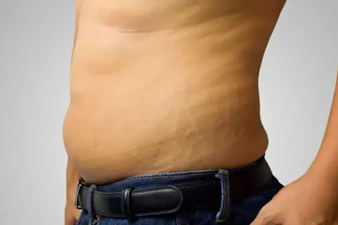 Primo piano della pancia di un uomo con smagliature visibili, segno di cambiamenti corporei.